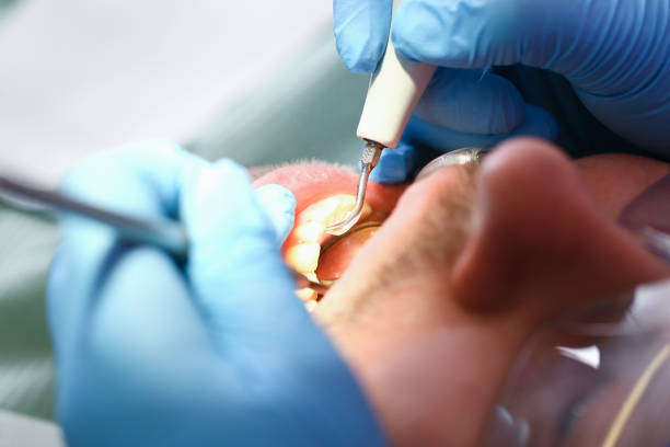 Best Emergency Treatment for Dental Infections or Abscesses in Brownsville, TX